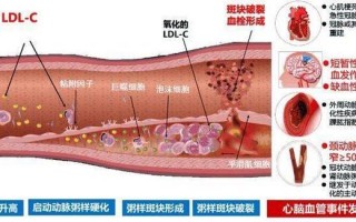 血管中的斑块如何去除？血管中有斑块该怎么办？(知乎）