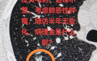 右肺上叶结节什么意思，右肺上叶小结节是什么意思(2024头条知乎已更新）