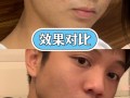 像素激光痘坑多少钱，像素激光治疗痘坑效果(2024头条知乎已更新）