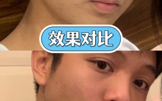 像素激光痘坑多少钱，像素激光治疗痘坑效果(2024头条知乎已更新）
