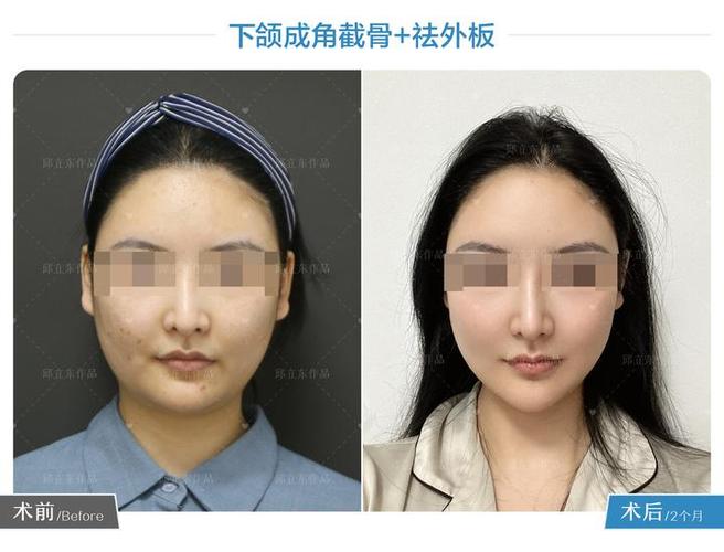 整容脸部削骨多少钱,整容削骨有风险大吗?(今日头条已更新)-第3张图片-汕团网 整容脸部削骨多少钱,整容削骨有风险大吗?(今日头条已更新)-第3张图片-汕团网