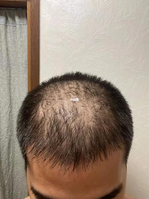 压力性脱发多久能恢复,压力性脱发多久能恢复正常?(今日头条已更新)-第1张图片-书同文历史百科 压力性脱发多久能恢复,压力性脱发多久能恢复正常?(今日头条已更新)-第1张图片-书同文历史百科