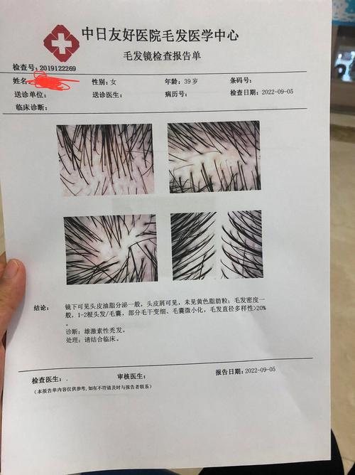 压力性脱发多久能恢复,压力性脱发多久能恢复正常?(今日头条已更新)-第2张图片-书同文历史百科 压力性脱发多久能恢复,压力性脱发多久能恢复正常?(今日头条已更新)-第2张图片-书同文历史百科