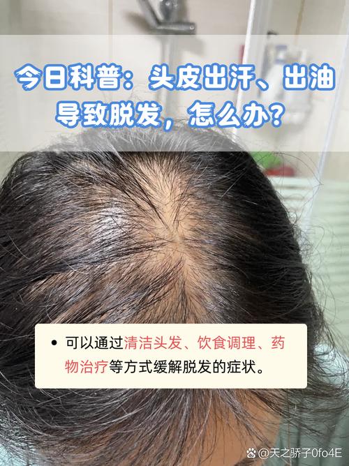 压力性脱发多久能恢复,压力性脱发多久能恢复正常?(今日头条已更新)-第4张图片-书同文历史百科 压力性脱发多久能恢复,压力性脱发多久能恢复正常?(今日头条已更新)-第4张图片-书同文历史百科