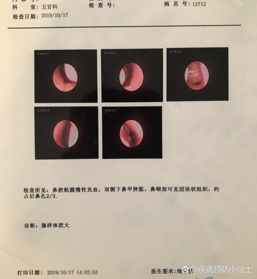 腺样体是哪里,儿童腺样体肥大最佳治疗方法(2024头条知乎已更新)-第1张图片-书同文历史百科 腺样体是哪里,儿童腺样体肥大最佳治疗方法(2024头条知乎已更新)-第1张图片-书同文历史百科