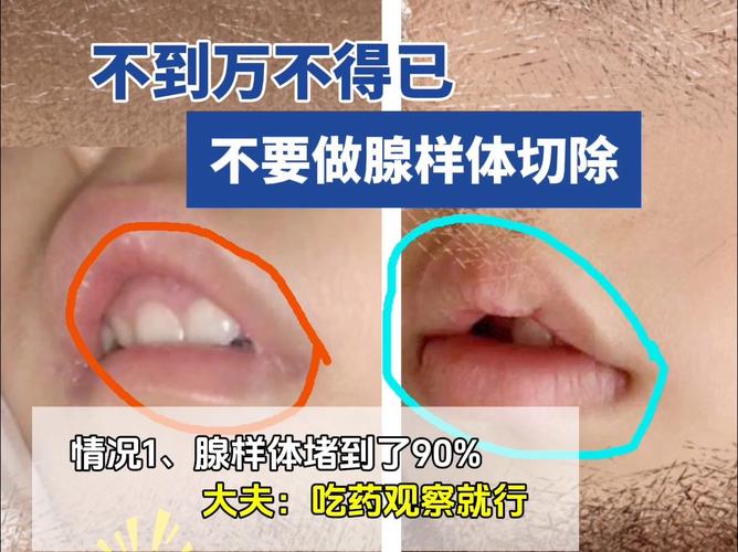 腺样体是哪里,儿童腺样体肥大最佳治疗方法(2024头条知乎已更新)-第3张图片-书同文历史百科 腺样体是哪里,儿童腺样体肥大最佳治疗方法(2024头条知乎已更新)-第3张图片-书同文历史百科
