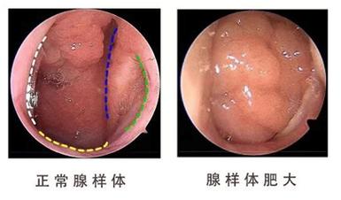 腺样体是哪里,儿童腺样体肥大最佳治疗方法(2024头条知乎已更新)-第5张图片-书同文历史百科 腺样体是哪里,儿童腺样体肥大最佳治疗方法(2024头条知乎已更新)-第5张图片-书同文历史百科