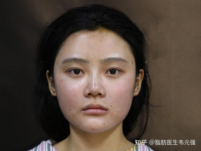 脂肪填充能维持多久,下巴脂肪填充能维持多久?(今日头条已更新)-第5张图片-汕团网 脂肪填充能维持多久,下巴脂肪填充能维持多久?(今日头条已更新)-第5张图片-汕团网