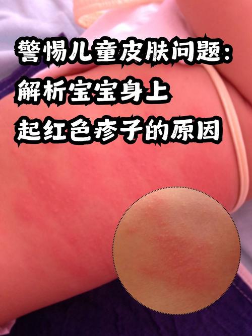 小孩身上痒是怎么回事,小孩身上痒是怎么回事挠了还起红疙瘩(2024头条知乎已更新)-第4张图片-汕团网 小孩身上痒是怎么回事,小孩身上痒是怎么回事挠了还起红疙瘩(2024头条知乎已更新)-第4张图片-汕团网
