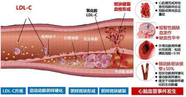 血管中的斑块如何去除?血管中有斑块该怎么办?(知乎)-第1张图片-汕团网 血管中的斑块如何去除?血管中有斑块该怎么办?(知乎)-第1张图片-汕团网