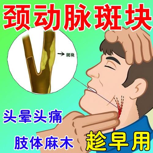 血管中的斑块如何去除?血管中有斑块该怎么办?(知乎)-第2张图片-汕团网 血管中的斑块如何去除?血管中有斑块该怎么办?(知乎)-第2张图片-汕团网