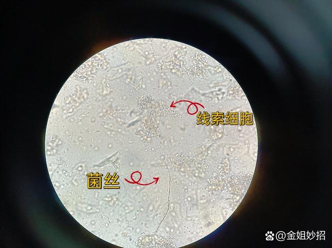 线索细胞是什么,线索细胞是什么妇科病?(今日头条已更新)-第3张图片-汕团网 线索细胞是什么,线索细胞是什么妇科病?(今日头条已更新)-第3张图片-汕团网