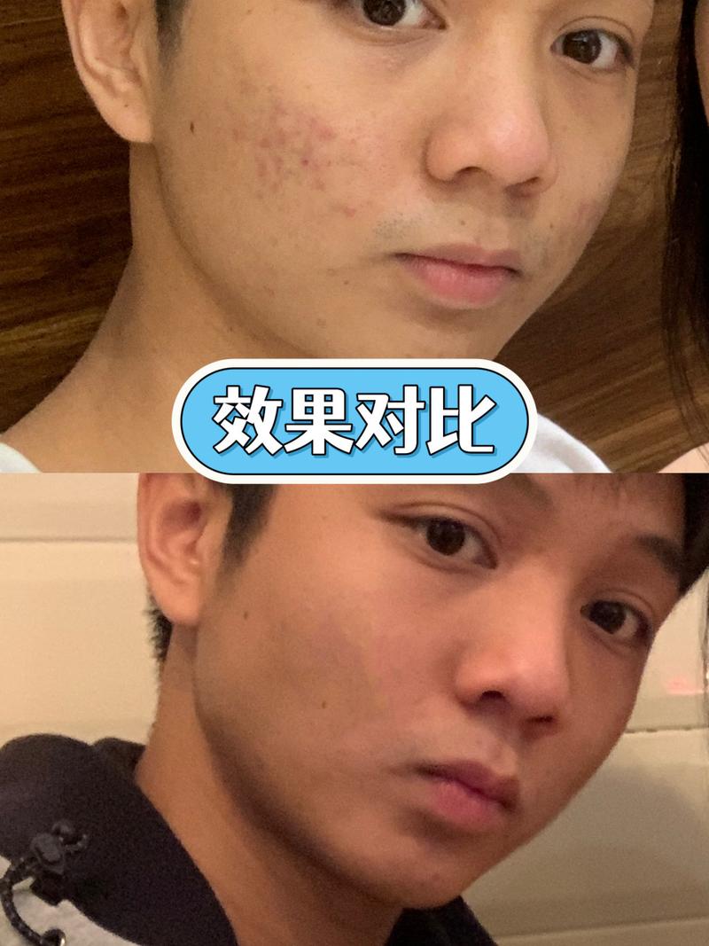 像素激光痘坑多少钱,像素激光治疗痘坑效果(2024头条知乎已更新)-第1张图片-汕团网 像素激光痘坑多少钱,像素激光治疗痘坑效果(2024头条知乎已更新)-第1张图片-汕团网