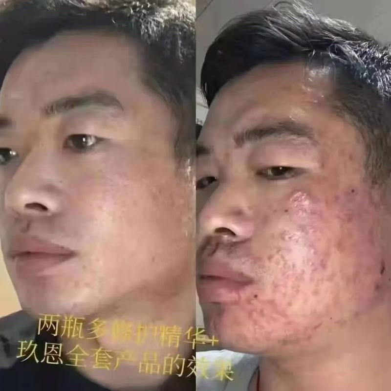像素激光痘坑多少钱,像素激光治疗痘坑效果(2024头条知乎已更新)-第3张图片-汕团网 像素激光痘坑多少钱,像素激光治疗痘坑效果(2024头条知乎已更新)-第3张图片-汕团网