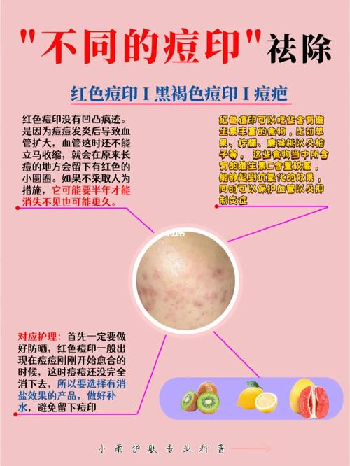 像素激光痘坑多少钱,像素激光治疗痘坑效果(2024头条知乎已更新)-第4张图片-汕团网 像素激光痘坑多少钱,像素激光治疗痘坑效果(2024头条知乎已更新)-第4张图片-汕团网