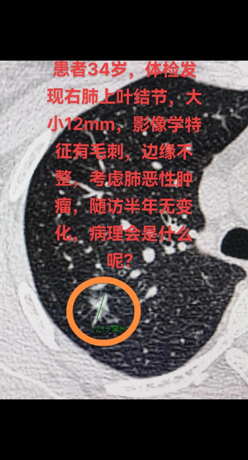 右肺上叶结节什么意思,右肺上叶小结节是什么意思(2024头条知乎已更新)-第1张图片-汕团网 右肺上叶结节什么意思,右肺上叶小结节是什么意思(2024头条知乎已更新)-第1张图片-汕团网