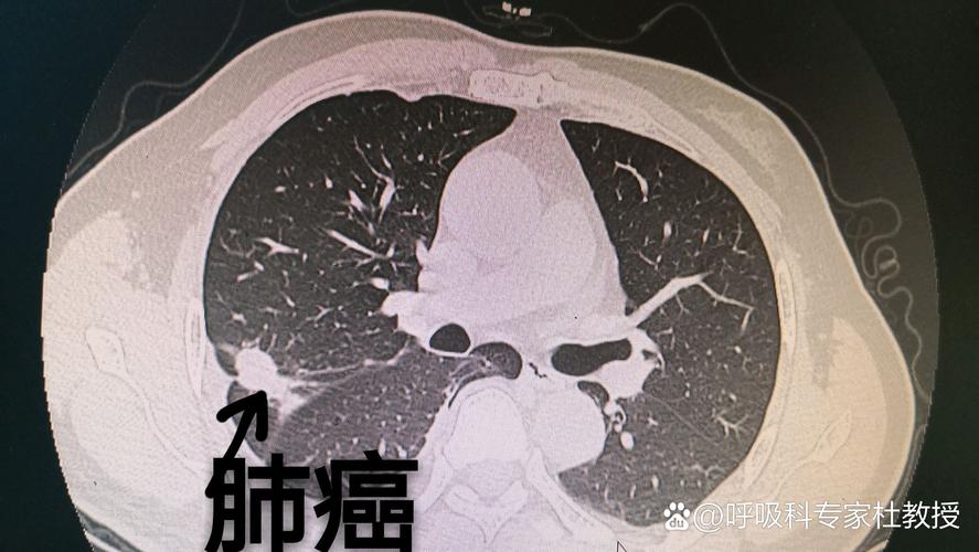 右肺上叶结节什么意思,右肺上叶小结节是什么意思(2024头条知乎已更新)-第4张图片-汕团网 右肺上叶结节什么意思,右肺上叶小结节是什么意思(2024头条知乎已更新)-第4张图片-汕团网