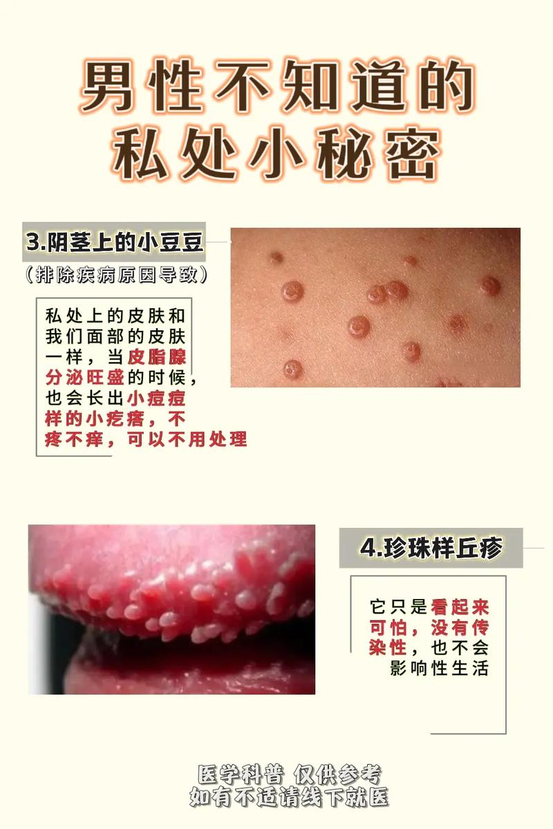 阴囊唇长了个小硬疙瘩是怎么回事?阴囊长了个小硬疙瘩是怎么回事?(知乎)-第3张图片-汕团网 阴囊唇长了个小硬疙瘩是怎么回事?阴囊长了个小硬疙瘩是怎么回事?(知乎)-第3张图片-汕团网