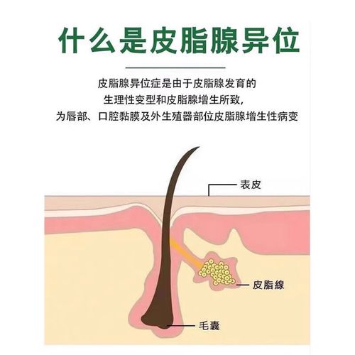 阴囊唇长了个小硬疙瘩是怎么回事?阴囊长了个小硬疙瘩是怎么回事?(知乎)-第5张图片-汕团网 阴囊唇长了个小硬疙瘩是怎么回事?阴囊长了个小硬疙瘩是怎么回事?(知乎)-第5张图片-汕团网